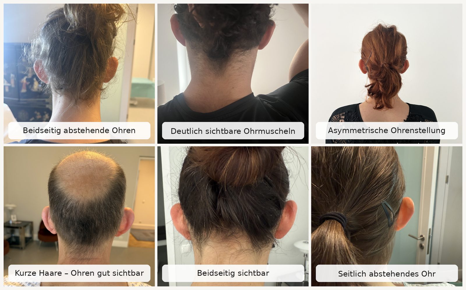 Anzeichen für abstehende Ohren Sechs Ansichten abstehender Ohren: beidseitig, asymmetrisch und seitlich abstehend, mit kurzen und hochgesteckten Haaren